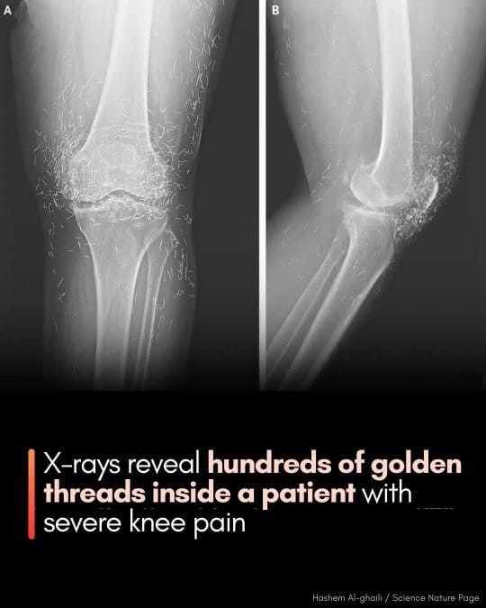 Hundreds of Gold Threads Found in Woman’s Knees After Acupuncture: A Shocking Case in South Korea