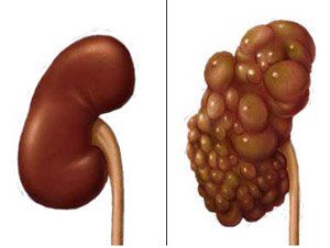 Kidney cysts : What Is It And How To Cure It