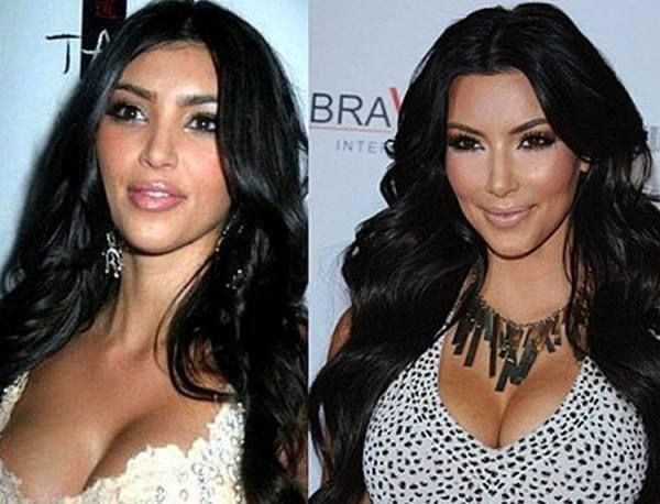 Celebrities' Plastic Surgery Nightmares Unveiled: The Most Shocking Transformations!
