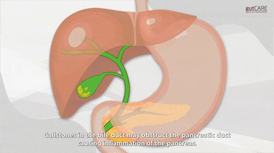 Scientists Eliminated Pancreatic Tumors in Mice — Why This Breakthrough Matters (and Why It’s Not a Cure Yet)